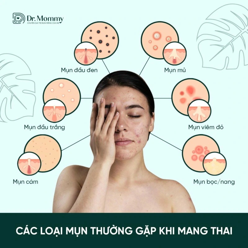 Làm sao hết mụn khi mang thai? Bí quyết chăm sóc da hiệu quả cho mẹ bầu