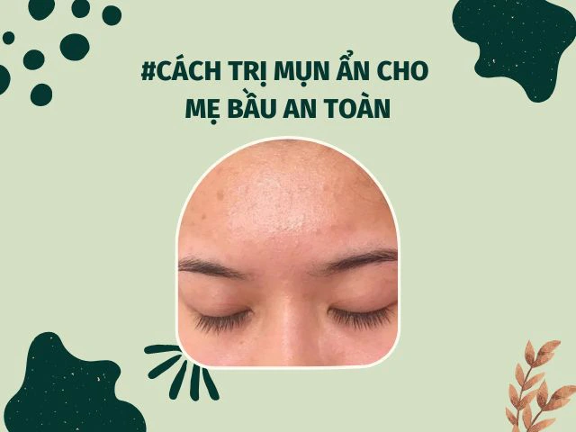 Trị Mụn Ẩn Cho Bà Bầu: Phương Pháp An Toàn Và Hiệu Quả