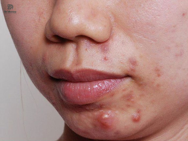 Mụn viêm có thể mọc ở nhiều khu vực trên cơ thể, đặc biệt là da mặt